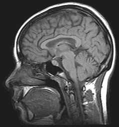 Gray Matter Imaging onthult afwijkingen bij progressieve MS, die op een standaard-MRI worden gemist